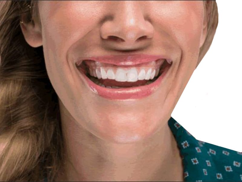 teeth alignment